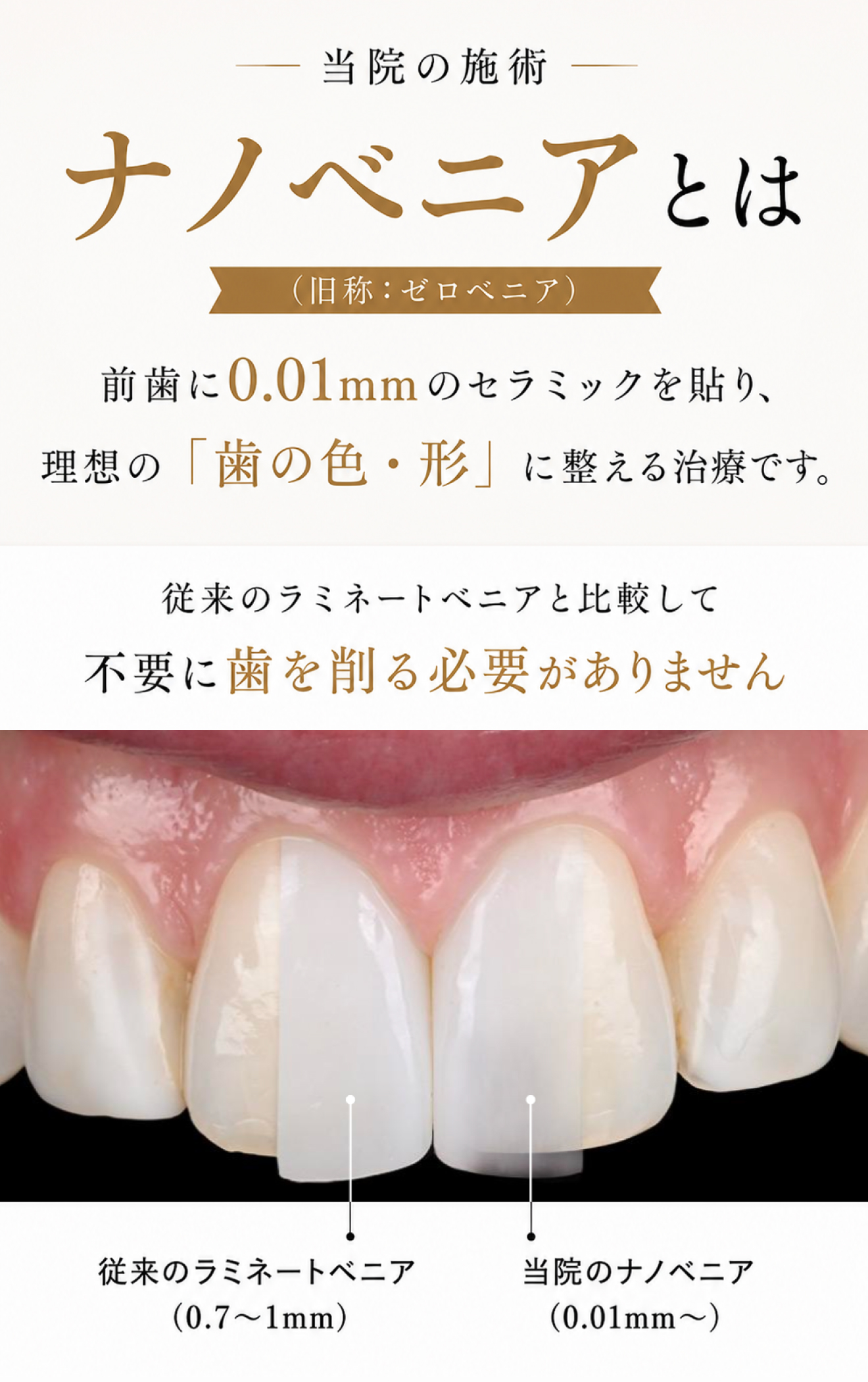 ナノベニアとは前歯に0.01mm-のセラミックを貼り理想の『歯の色・形』に整える治療