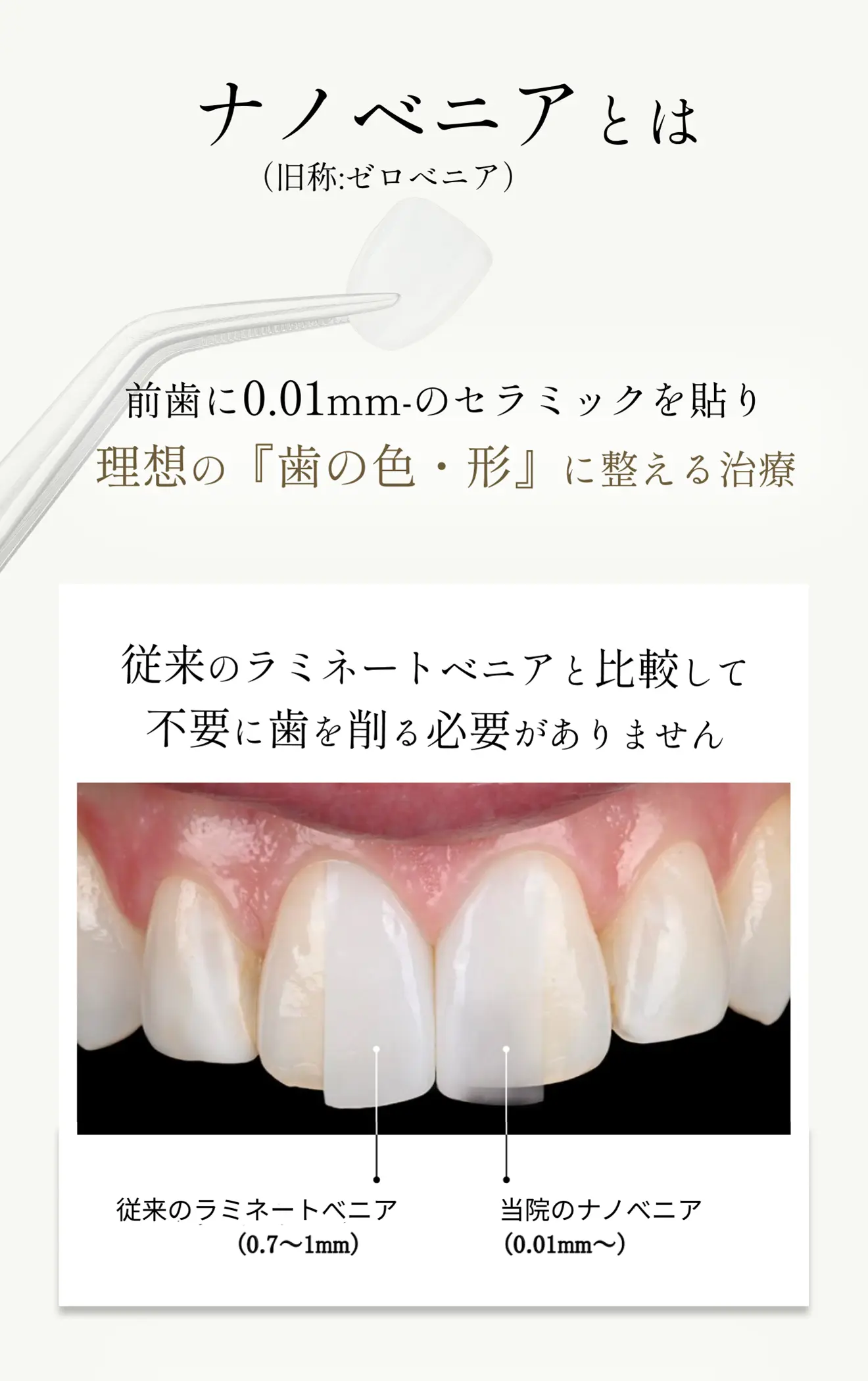 ナノベニアとは前歯に0.01mm-のセラミックを貼り理想の『歯の色・形』に整える治療
