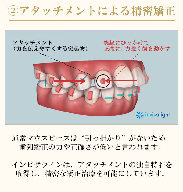 インビザラインのアタッチメント
