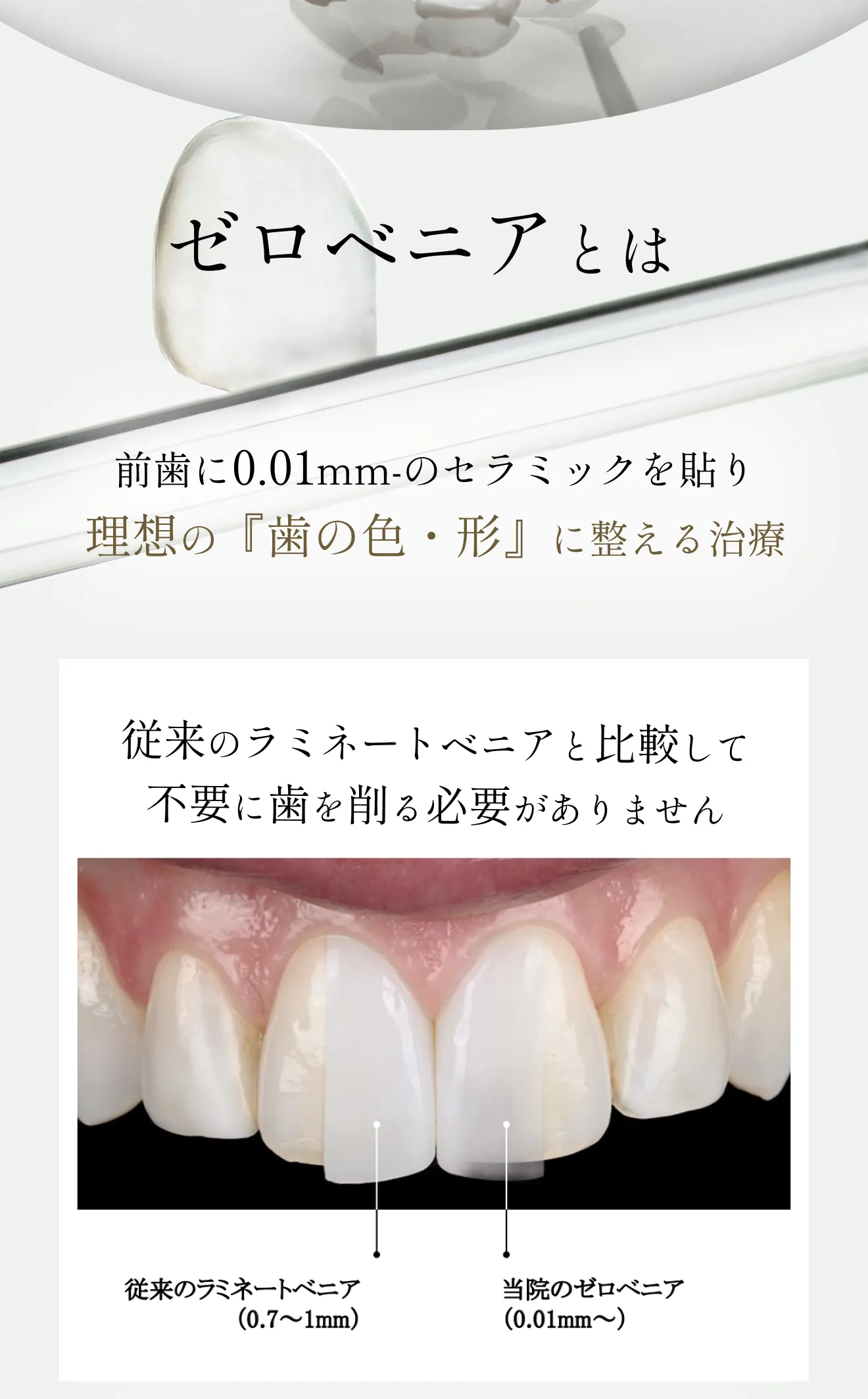 ゼロベニアとは前歯に0.01mm-のセラミックを貼り理想の『歯の色・形』に整える治療
