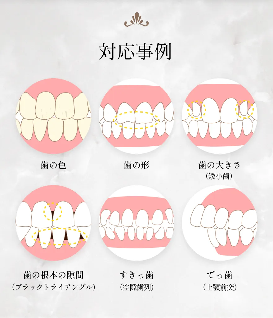 歯の色や形、大きさ、根本の隙間、すきっ歯、出っ歯などの対応事例イラスト
