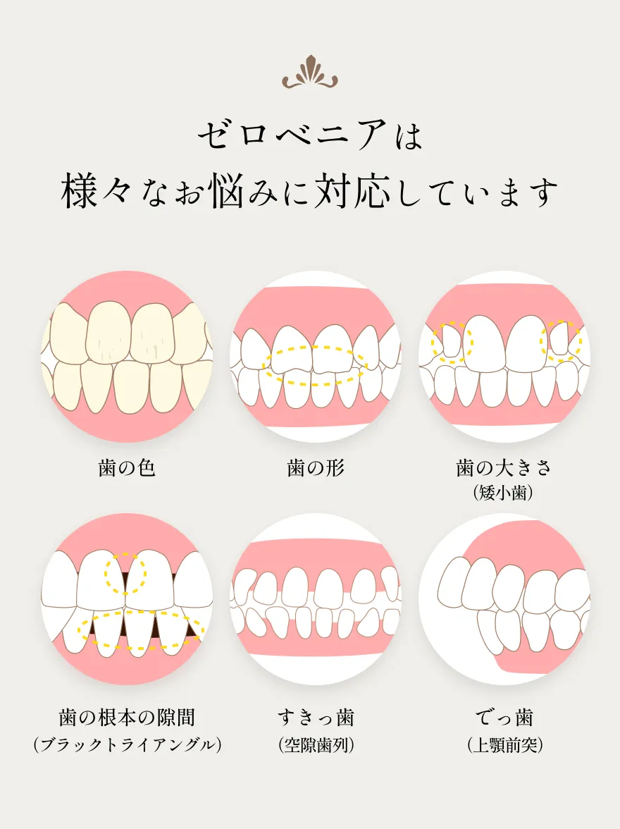 歯の色や形、大きさ、根本の隙間、すきっ歯、出っ歯などの対応事例イラスト